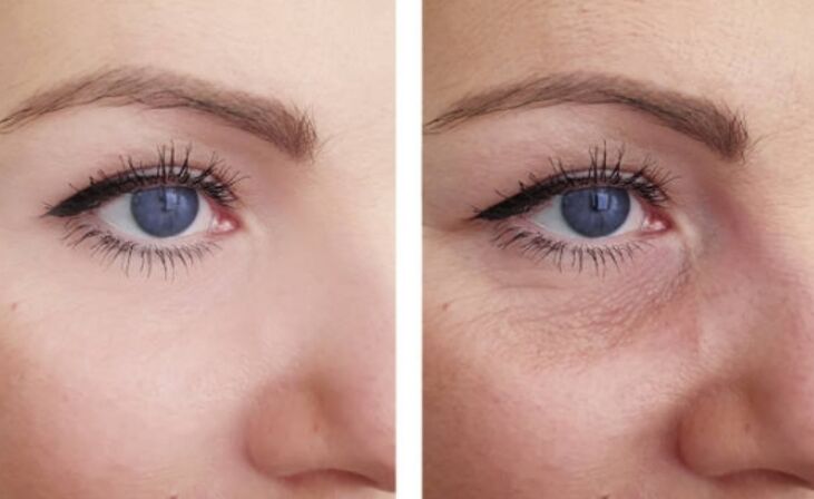 avant et après le rajeunissement au plasma autour des yeux