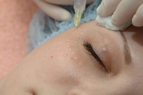 Mésothérapie - une méthode d'injection de rajeunissement de la peau du visage