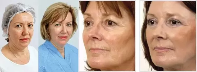 Le résultat du rajeunissement de la peau du visage au laser est la réduction des rides