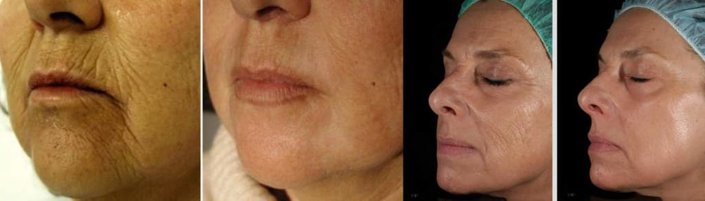 Peau du visage avant et après la procédure de rajeunissement au laser