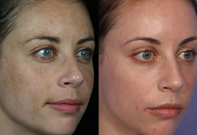 Traitement en cuir laser