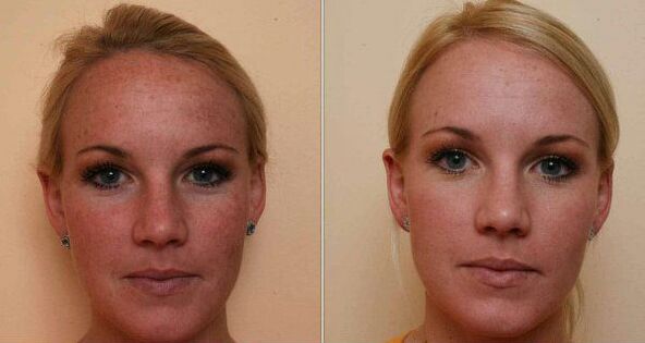 avant et après le rajeunissement de la peau du visage au laser