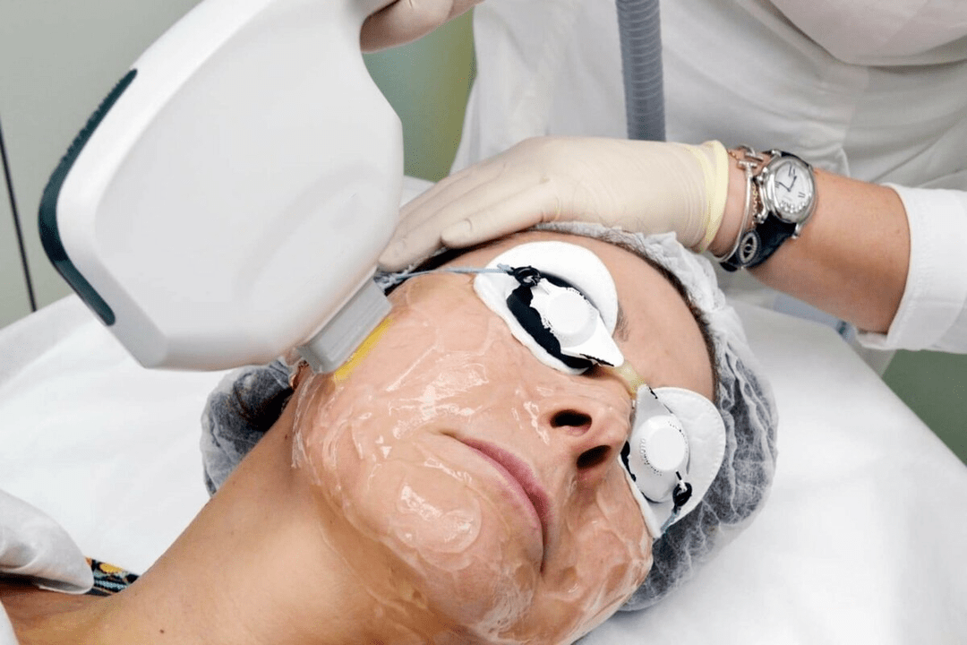 rajeunissement au laser pour la peau du visage