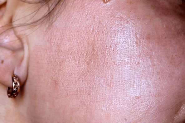 rougeur de la peau après le rajeunissement au laser