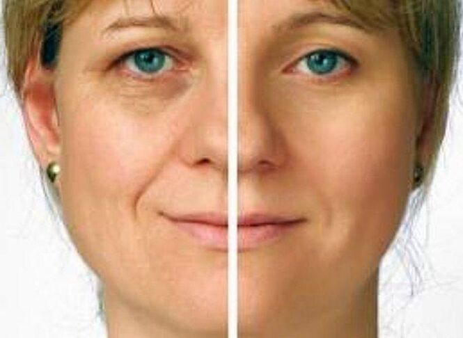 peau autour des yeux avant et après le rajeunissement