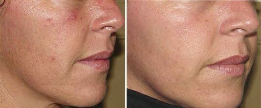 visage avant et après le rajeunissement de la peau du matériel